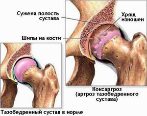 Коксартроз тазобедренного сустава лечение украина thumbnail