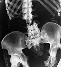 Перелом позвоночника человека на рентгеновском снимке